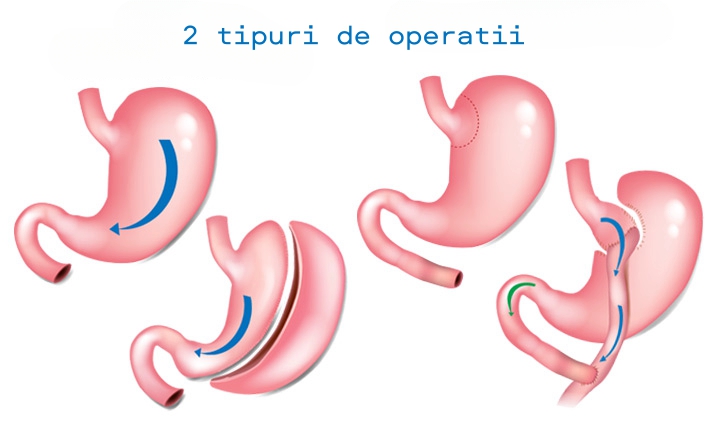 Operatie diabet tip 2